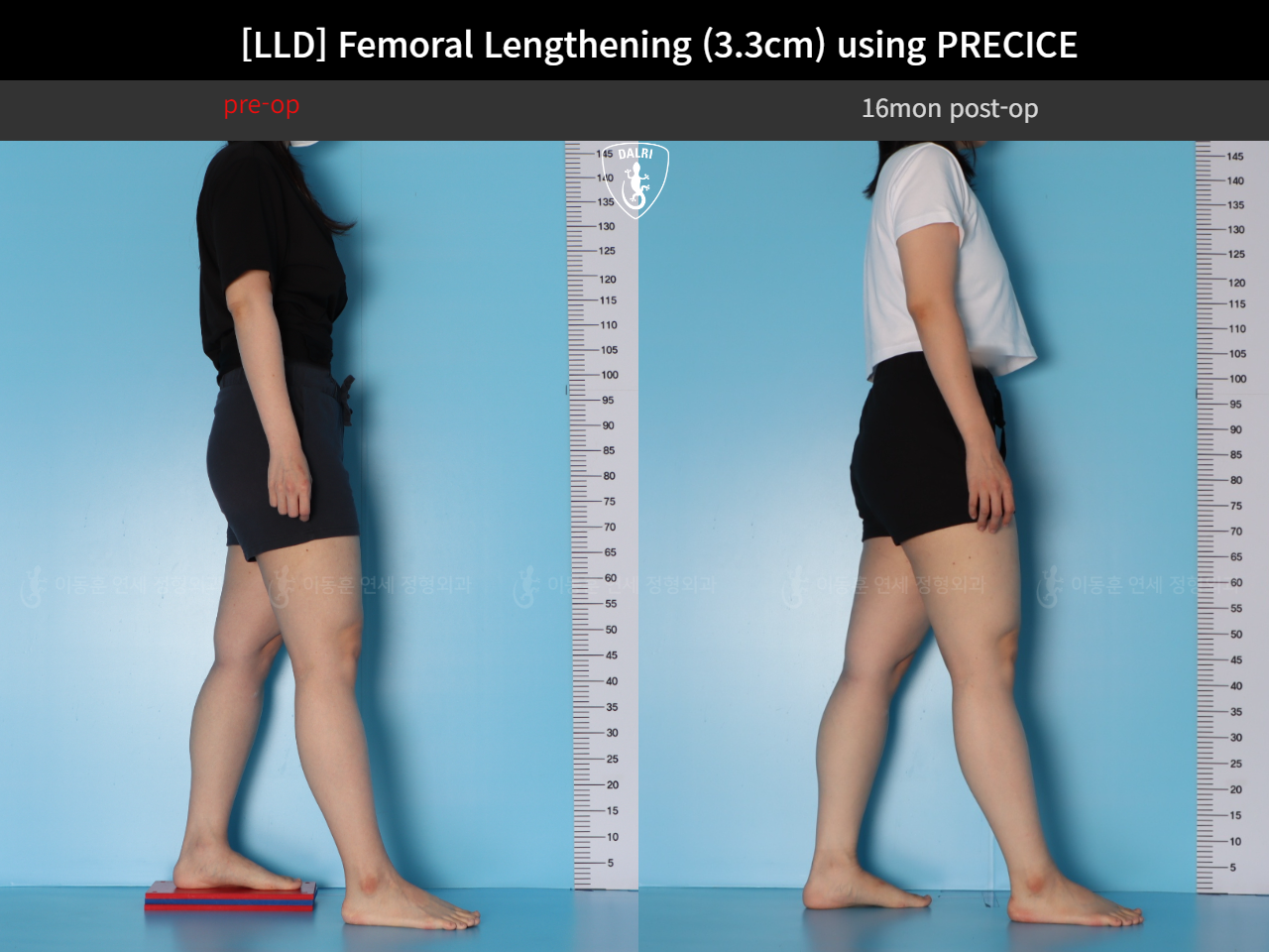 Before and after adult lld, case 125639660, image 4, Dr. Donghoon institute (DALRI)
