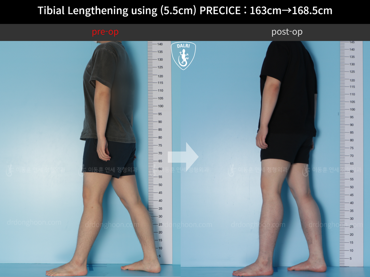 Before and after cll precice, case 12336162, image 3, Dr. Donghoon institute (DALRI)