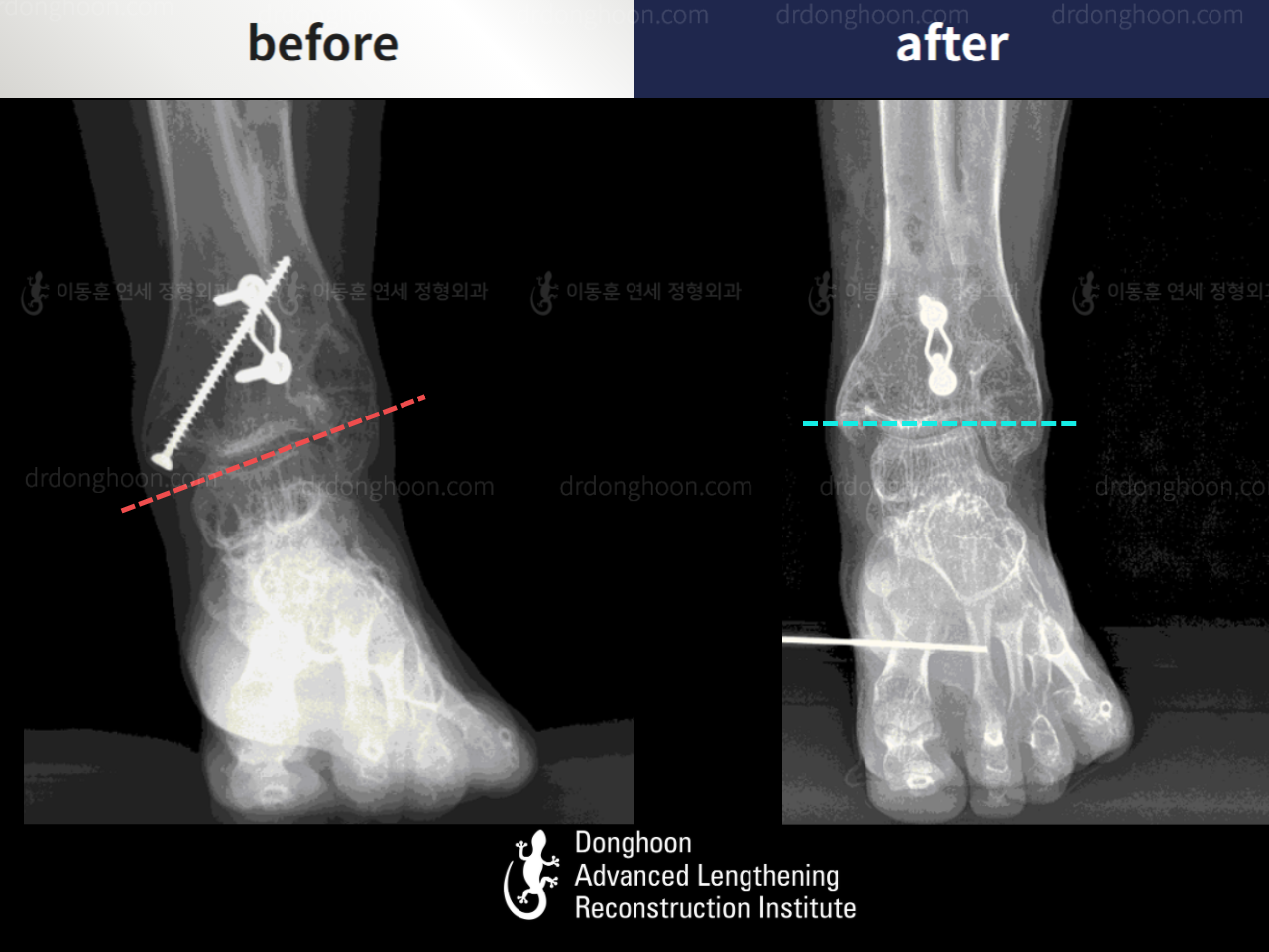 Before and after foot & ankle deformity, case 5313702, image 2, Dr. Donghoon institute (DALRI)