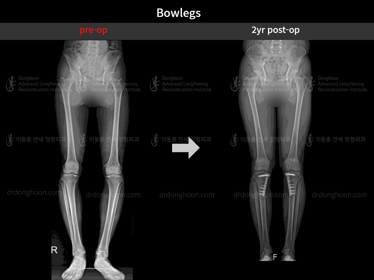 Before and after adult bowlegs, case 4311362, image 3, Dr. Donghoon institute (DALRI)
