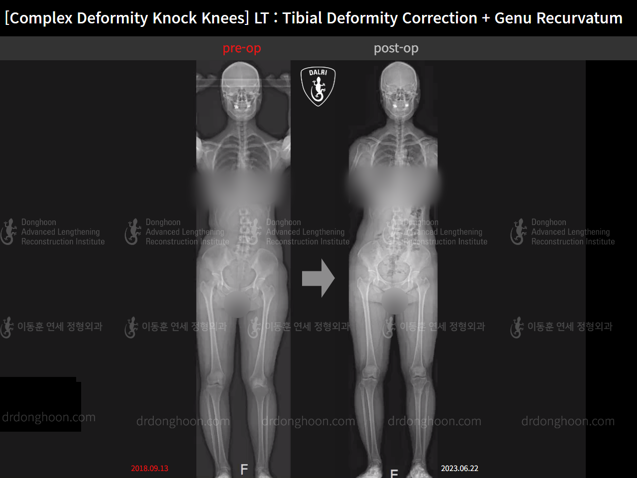 Before and after genu recurvatum, case 15801545, image 2, Dr. Donghoon institute (DALRI)