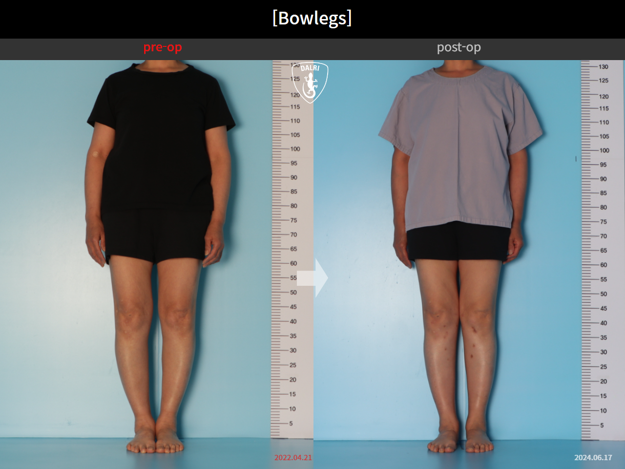 Before and after adult bowlegs, case 30770070, image 1, Dr. Donghoon institute (DALRI)