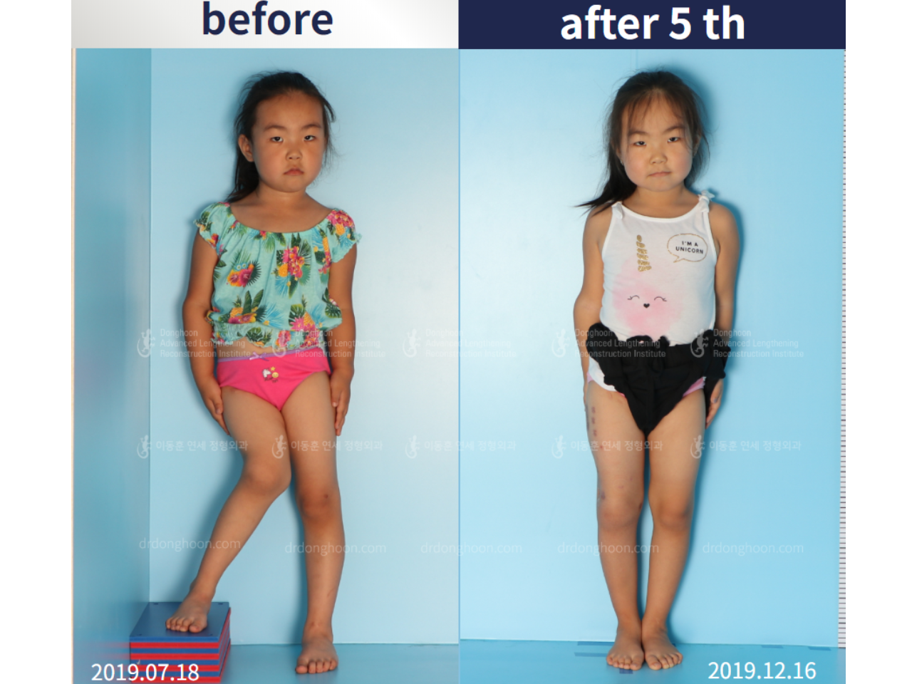 Before and after paediatric & adolescent lld, case 4577152, image 3, Dr. Donghoon institute (DALRI)