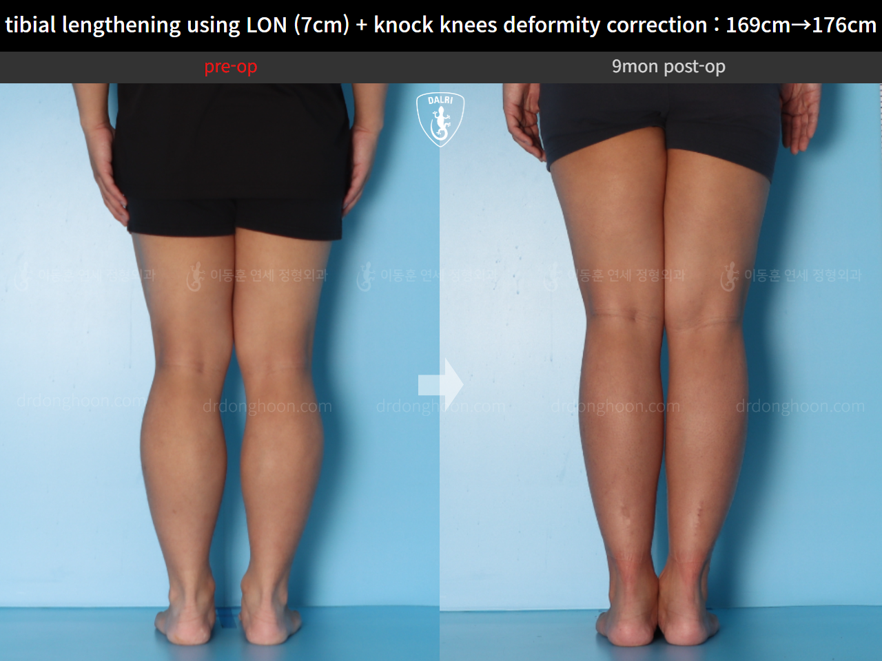 Before and after cll + deformity correction, case 15748291, image 5, Dr. Donghoon institute (DALRI)