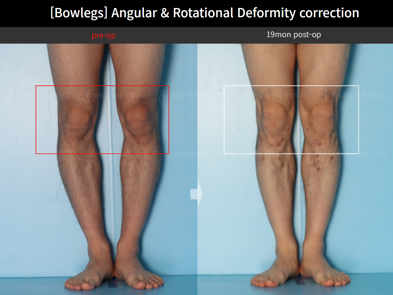 Before and after adult bowlegs, case 18306379, image 10, Dr. Donghoon institute (DALRI)