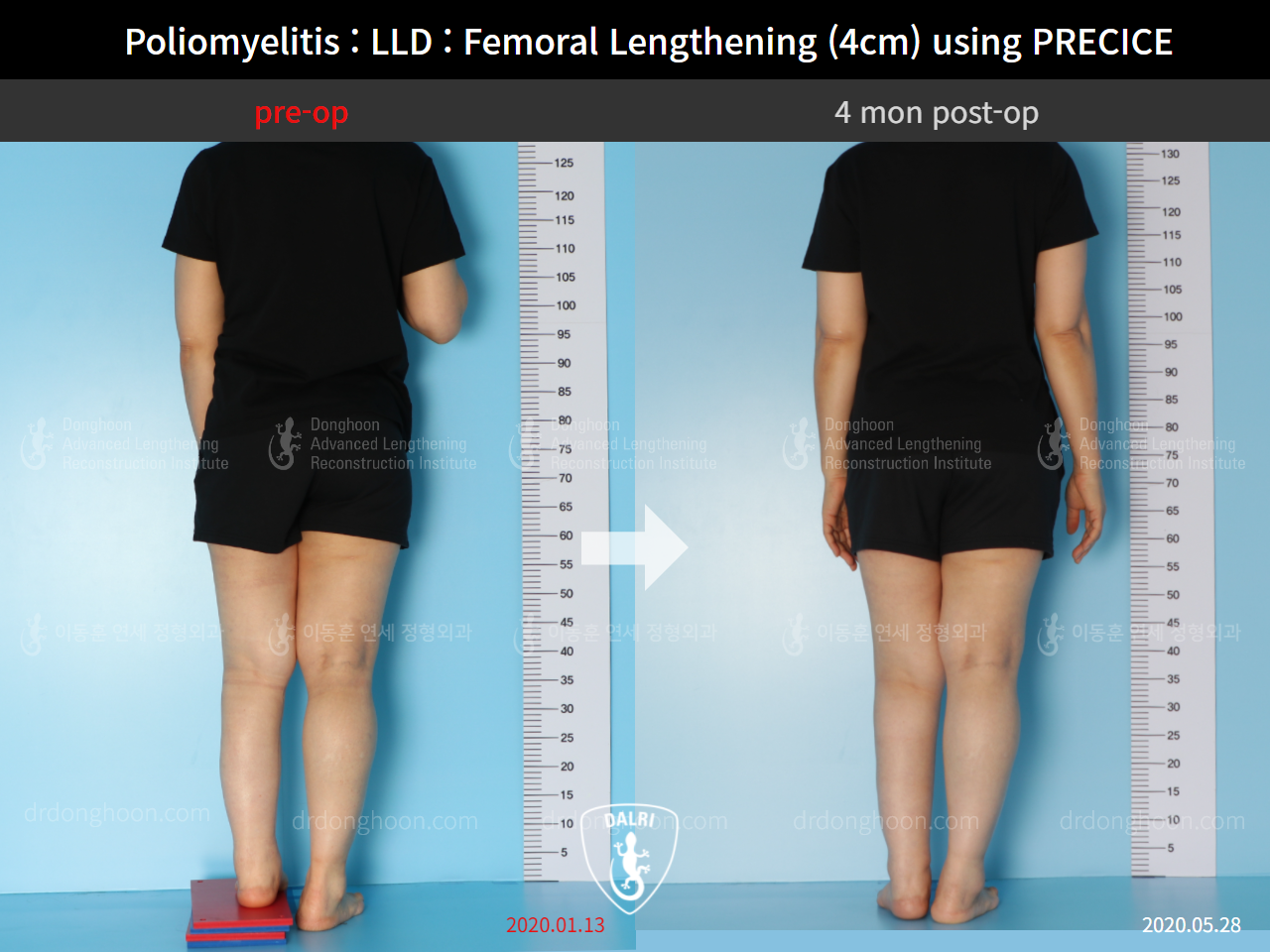 Before and after congenital condition, case 9191055, image 2, Dr. Donghoon institute (DALRI)