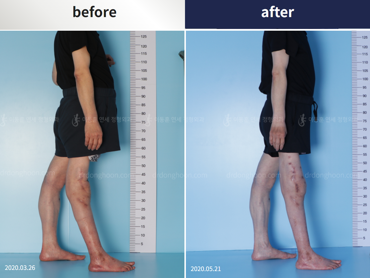 Before and after congenital condition, case 4304680, image 4, Dr. Donghoon institute (DALRI)