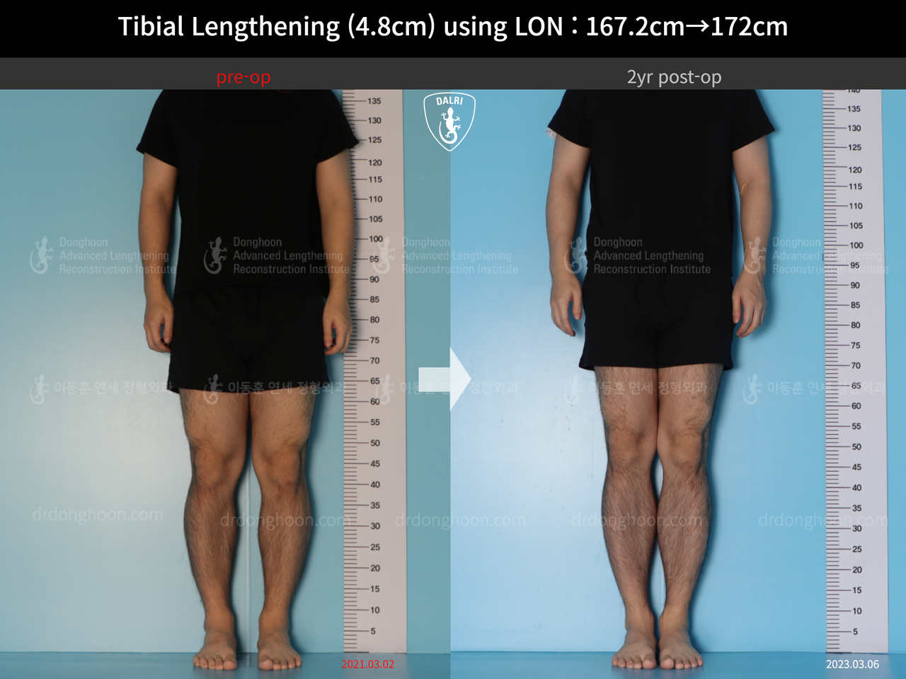 Before and after cll lon, case 14418932, image 1, Dr. Donghoon institute (DALRI)