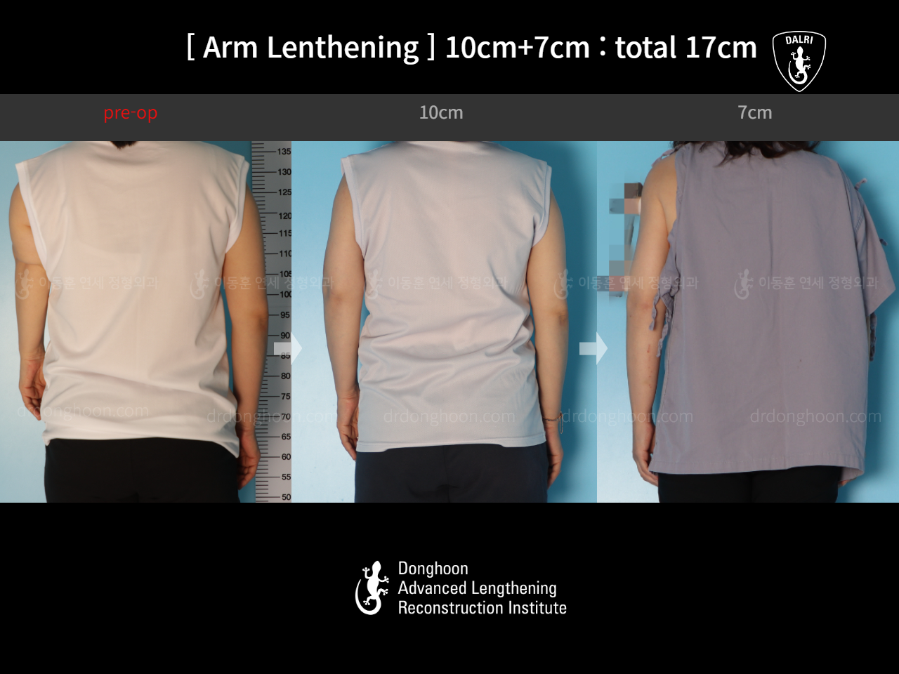 Before and after arm lengthening, case 17457909, image 2, Dr. Donghoon institute (DALRI)