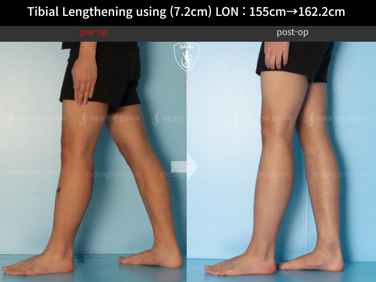 Before and after cll lon, case 13635674, image 9, Dr. Donghoon institute (DALRI)