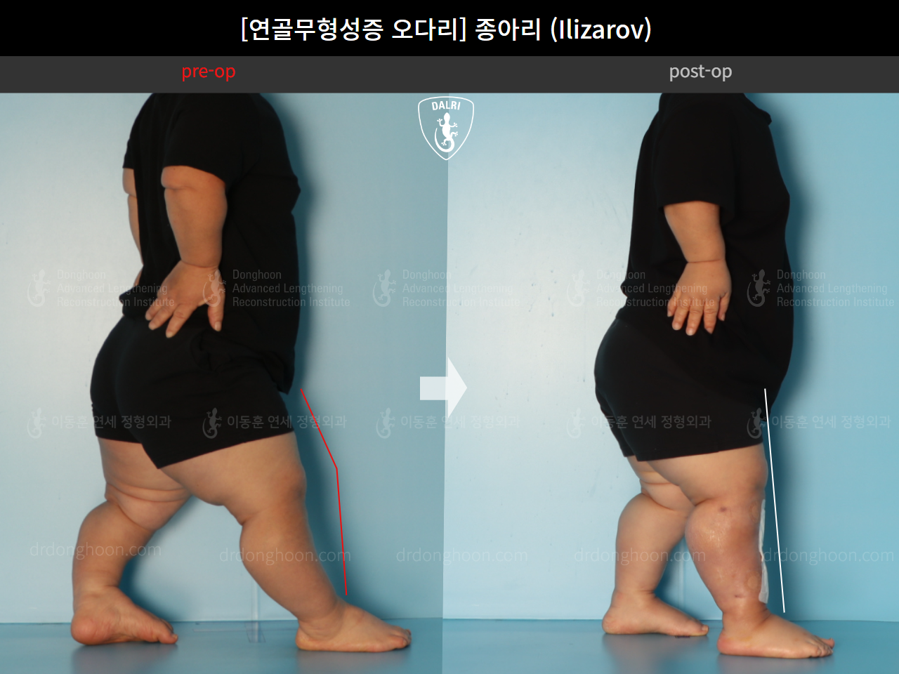 Before and after congenital condition, case 18077774, image 4, Dr. Donghoon institute (DALRI)