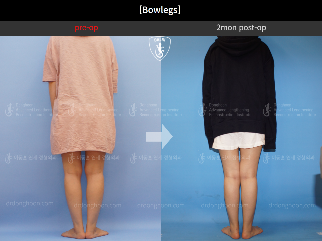 Before and after adult bowlegs, case 4310993, image 4, Dr. Donghoon institute (DALRI)
