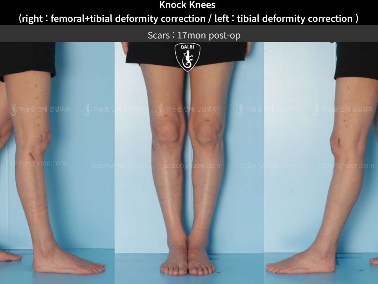 Before and after adult knock knees, case 4640565, image 5, Dr. Donghoon institute (DALRI)
