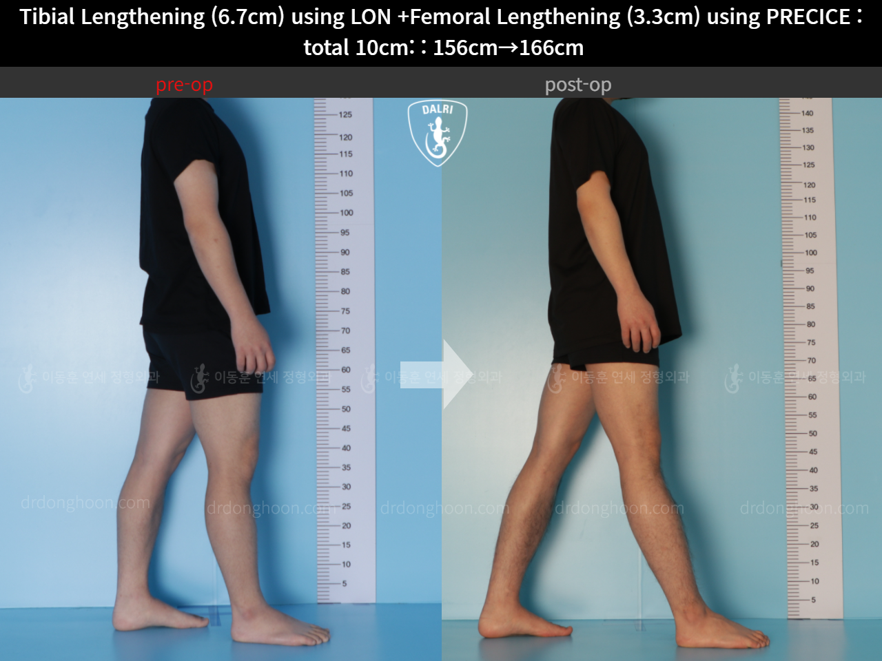 Tibial Lengthening (6.7cm) Using LON +Femoral Lengthening (3.3cm) Using ...