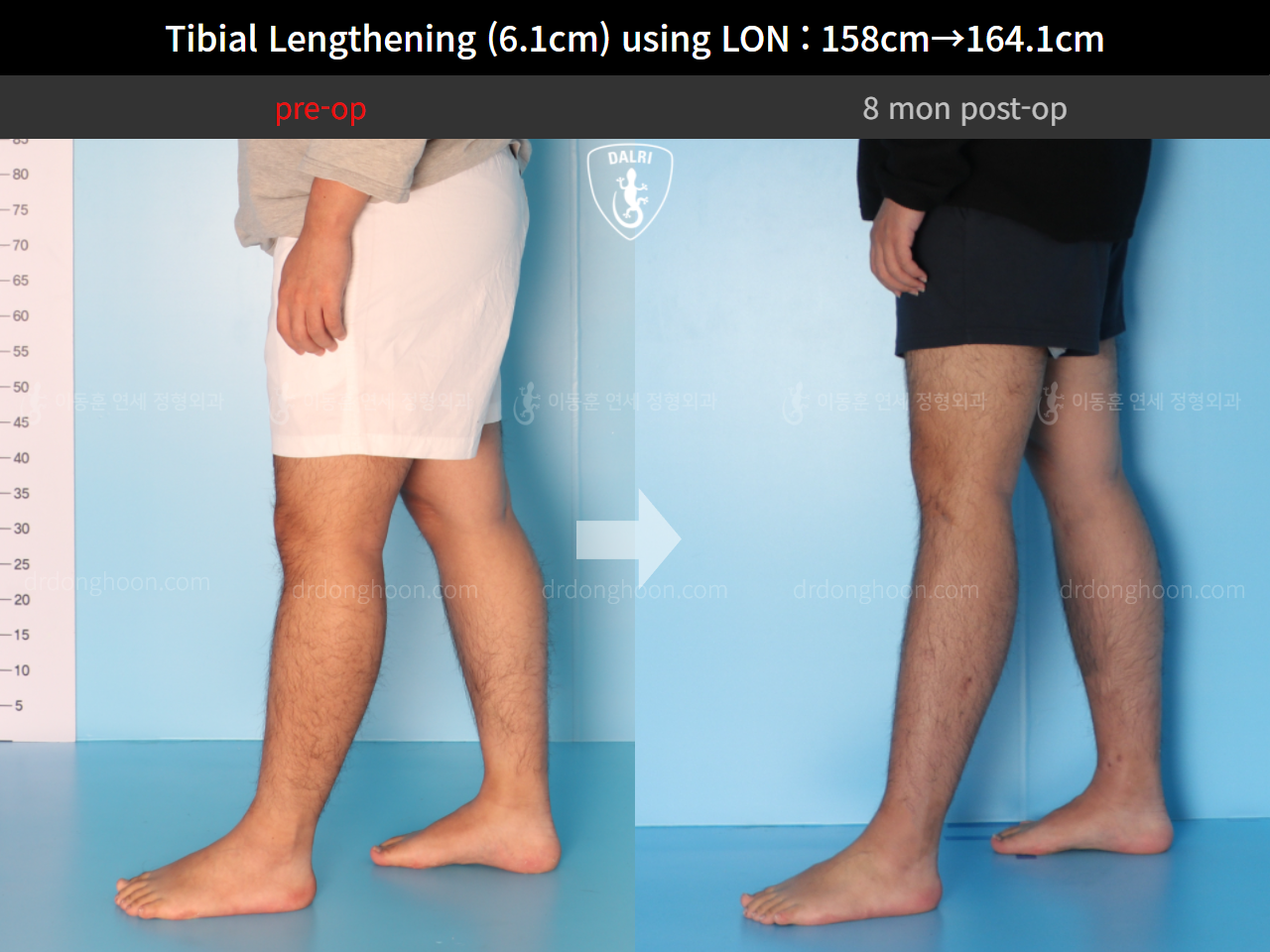 Before and after cll lon, case 4577743, image 7, Dr. Donghoon institute (DALRI)