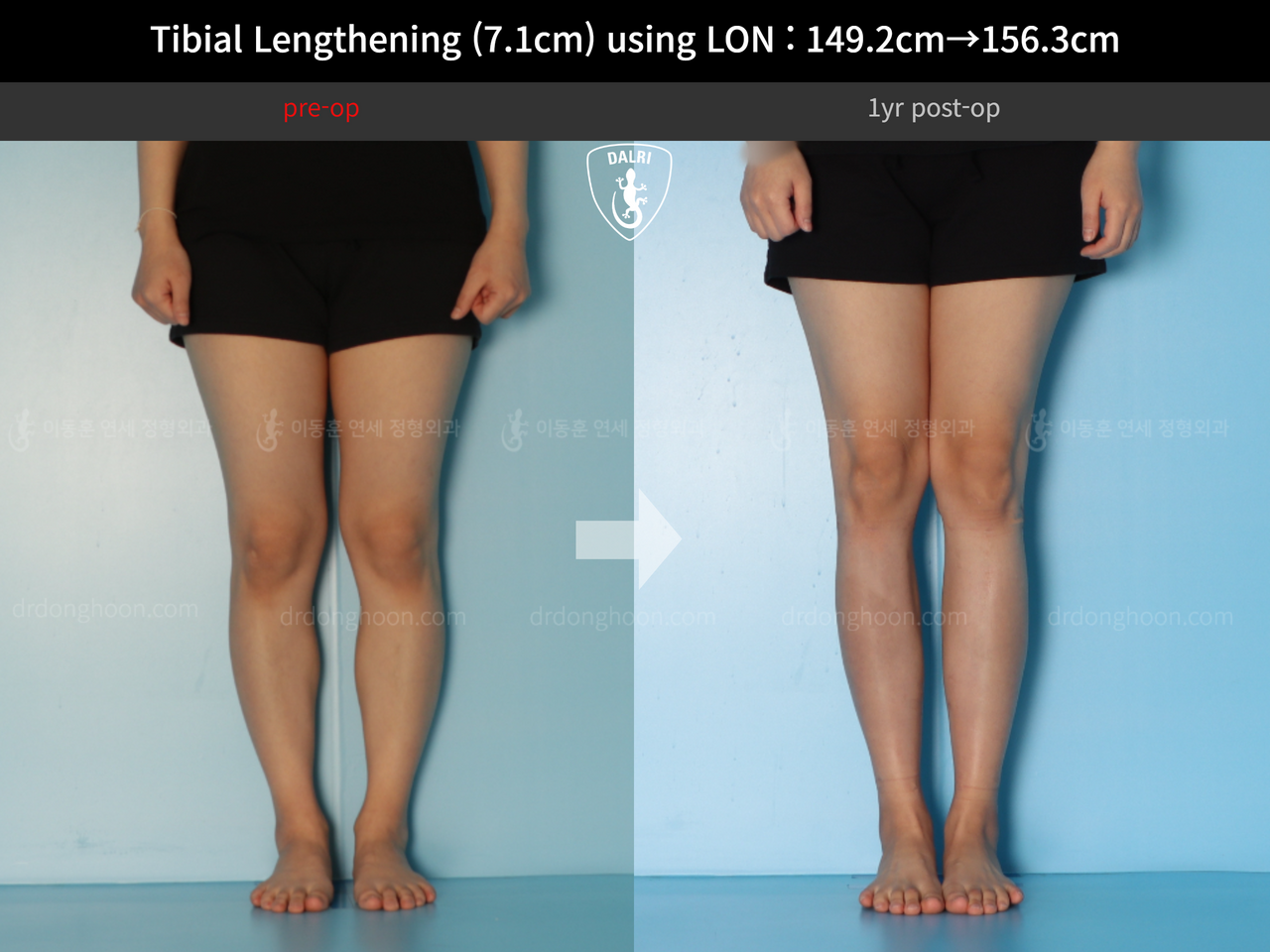 Before and after cll lon, case 14264800, image 5, Dr. Donghoon institute (DALRI)