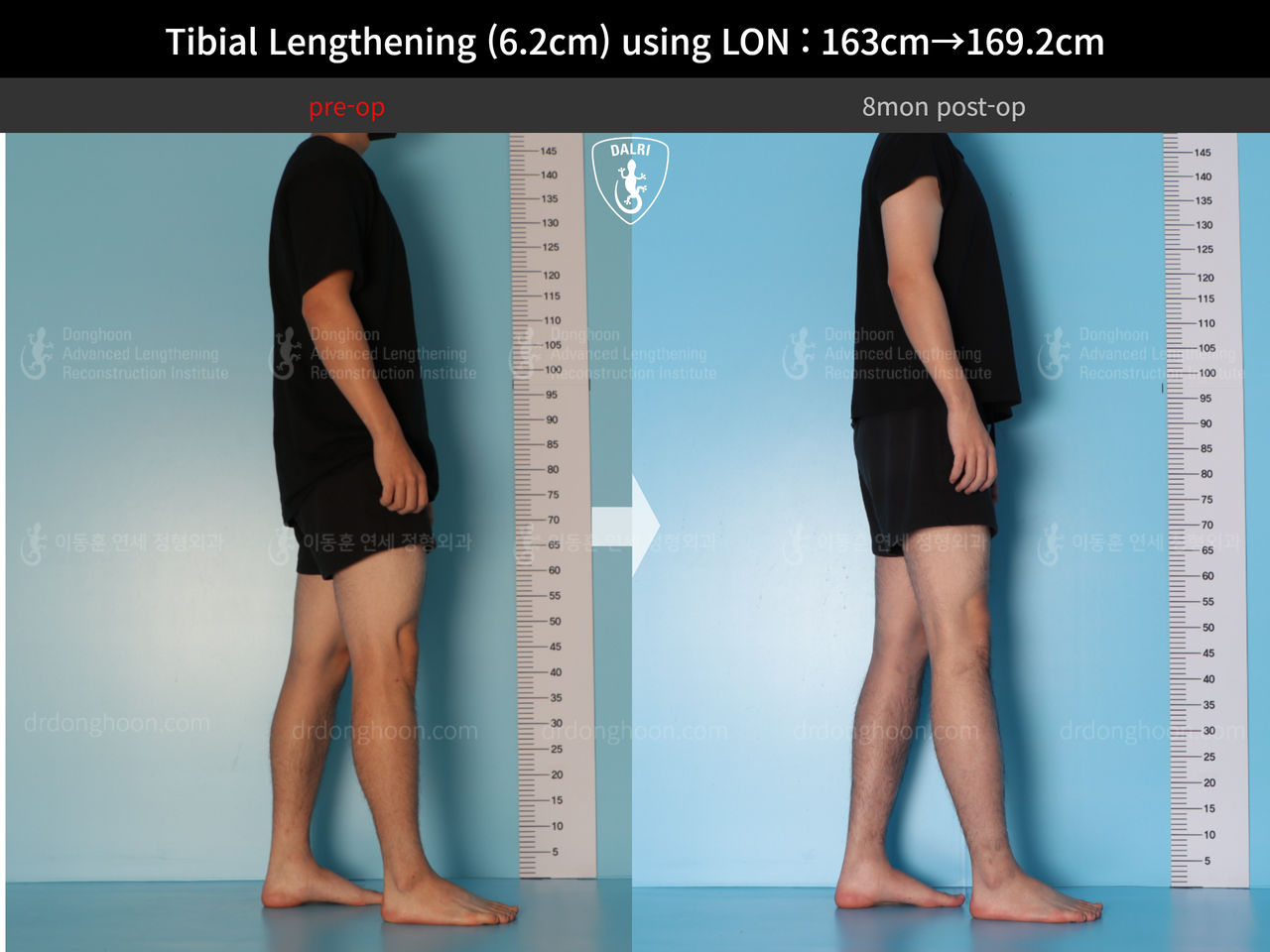 Before and after cll lon, case 14135787, image 3, Dr. Donghoon institute (DALRI)