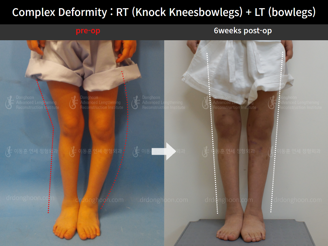 Before and after paediatric & adolescent knock knees, case 8618314, image 2, Dr. Donghoon institute (DALRI)