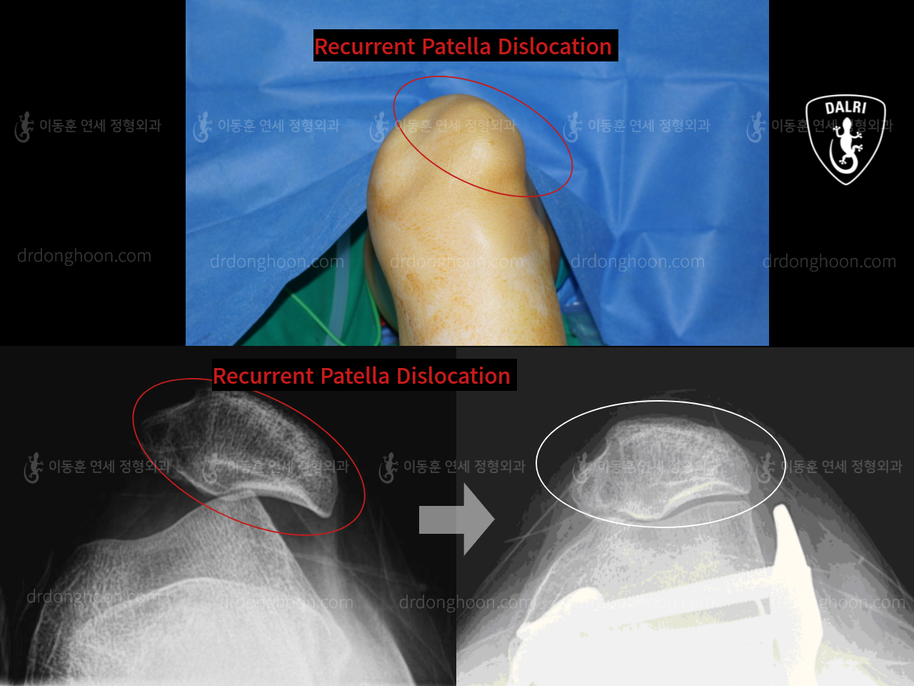 Before and after recurrent patella dislocation, case 10329296, image 1, Dr. Donghoon institute (DALRI)