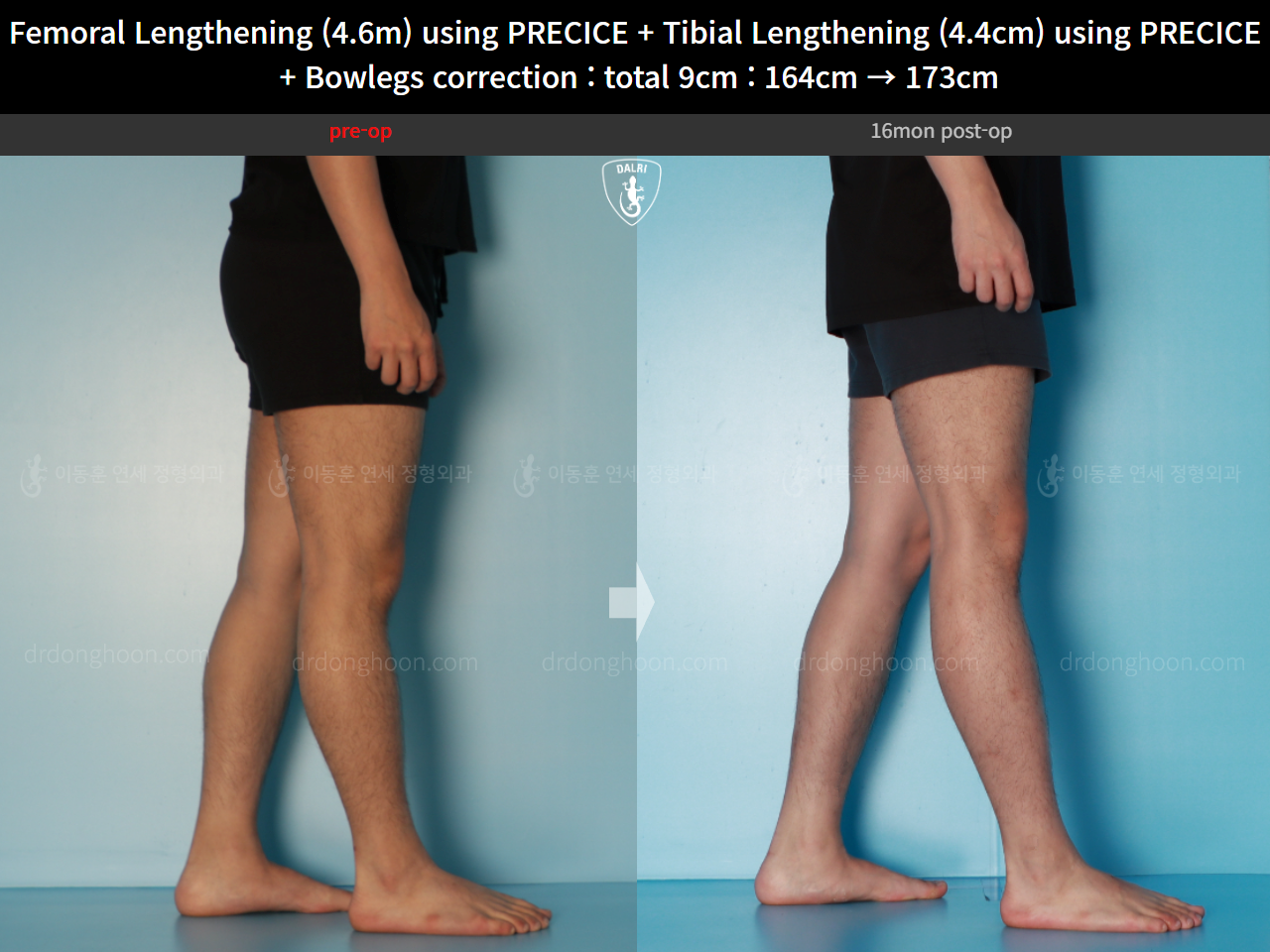 Before and after cll precice, case 16697524, image 11, Dr. Donghoon institute (DALRI)
