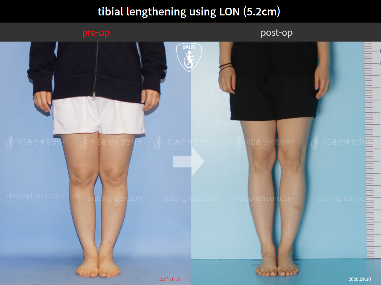 Before and after cll lon, case 4860933, image 5, Dr. Donghoon institute (DALRI)