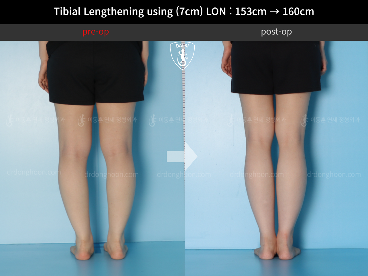Before and after cll lon, case 12679165, image 4, Dr. Donghoon institute (DALRI)