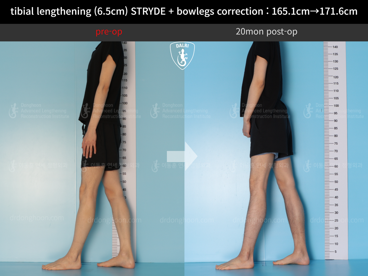 Before and after cll + deformity correction, case 13168253, image 6, Dr. Donghoon institute (DALRI)
