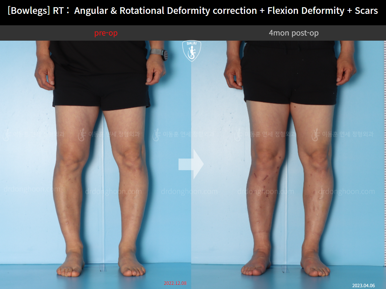 Before and after adult bowlegs, case 14701830, image 7, Dr. Donghoon institute (DALRI)