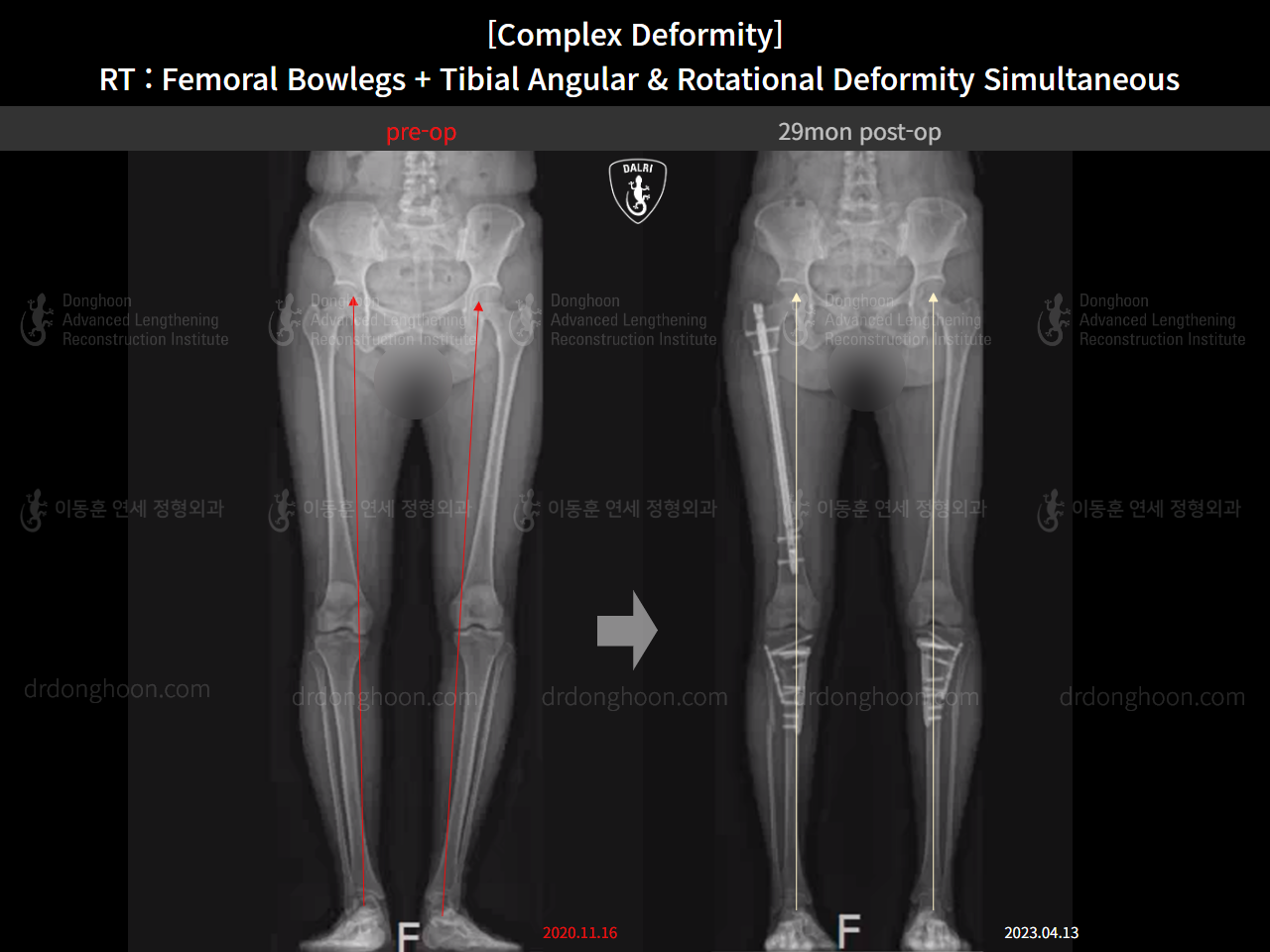 Before and after adult bowlegs, case 14771490, image 15, Dr. Donghoon institute (DALRI)
