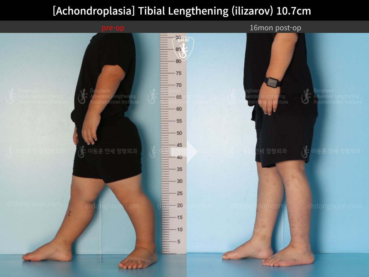 Before and after paediatric congenital condition, case 13489647, image 8, Dr. Donghoon institute (DALRI)