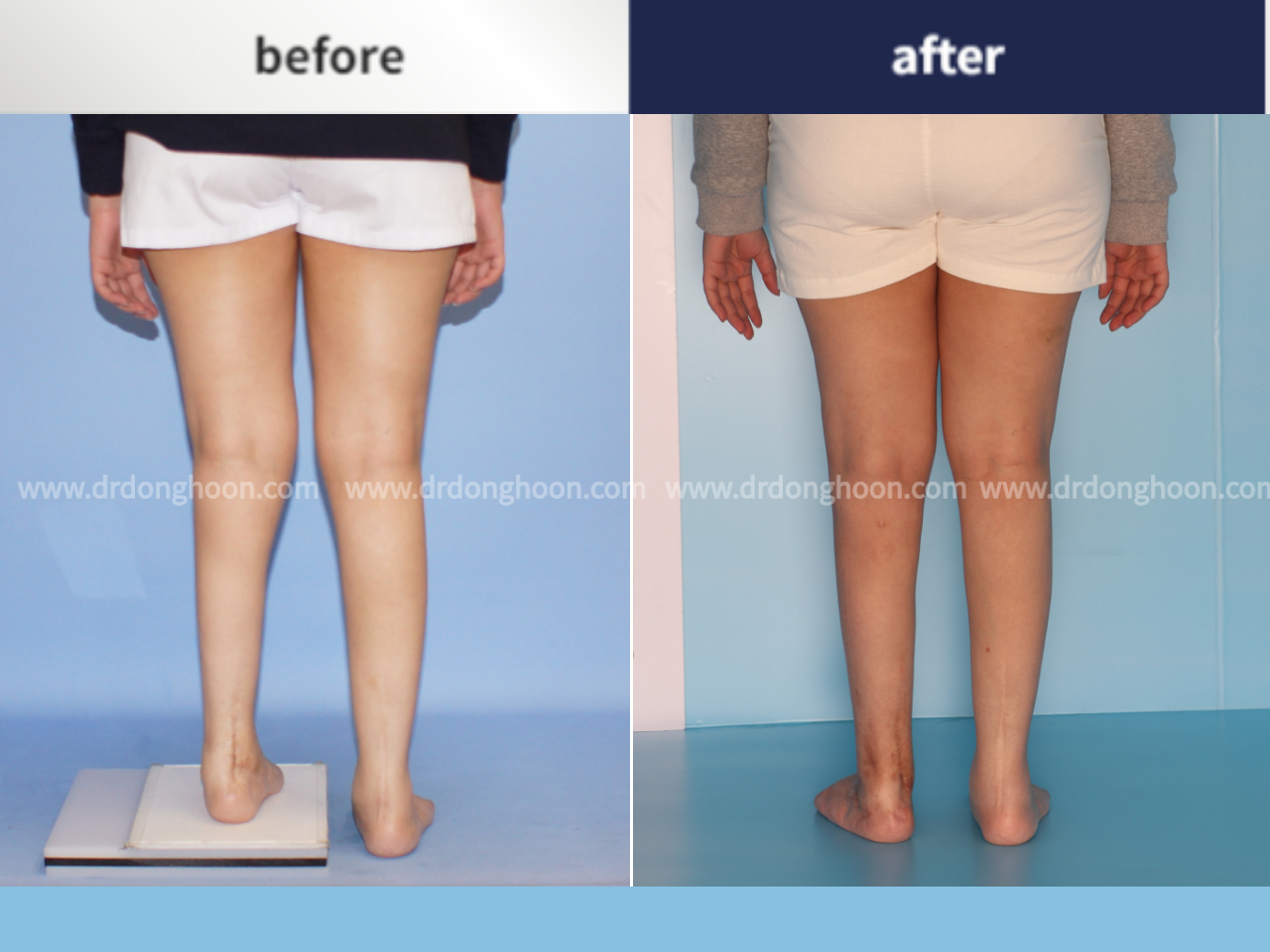 Before and after congenital condition, case 4795353, image 2, Dr. Donghoon institute (DALRI)