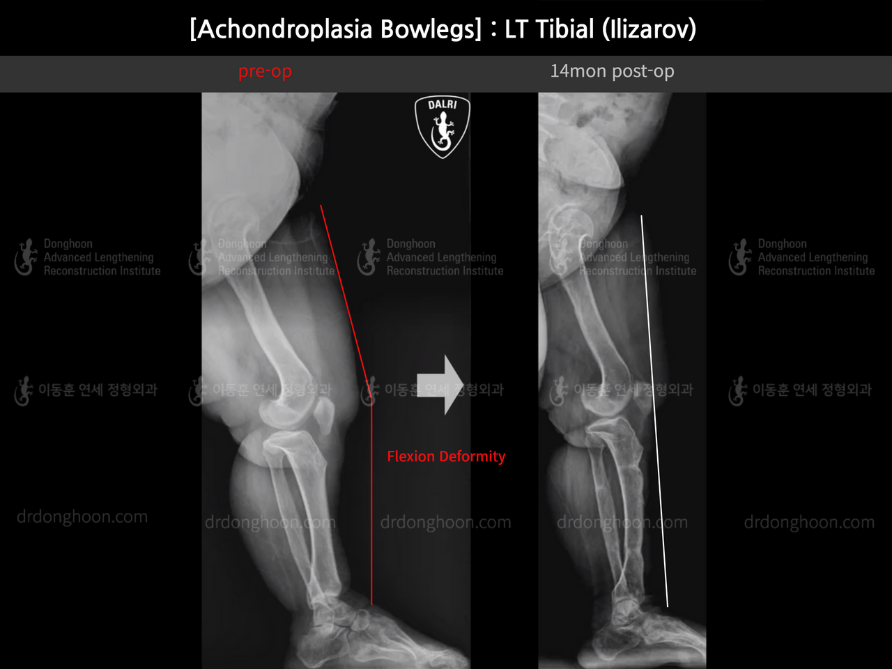 Before and after congenital condition, case 14296141, image 9, Dr. Donghoon institute (DALRI)