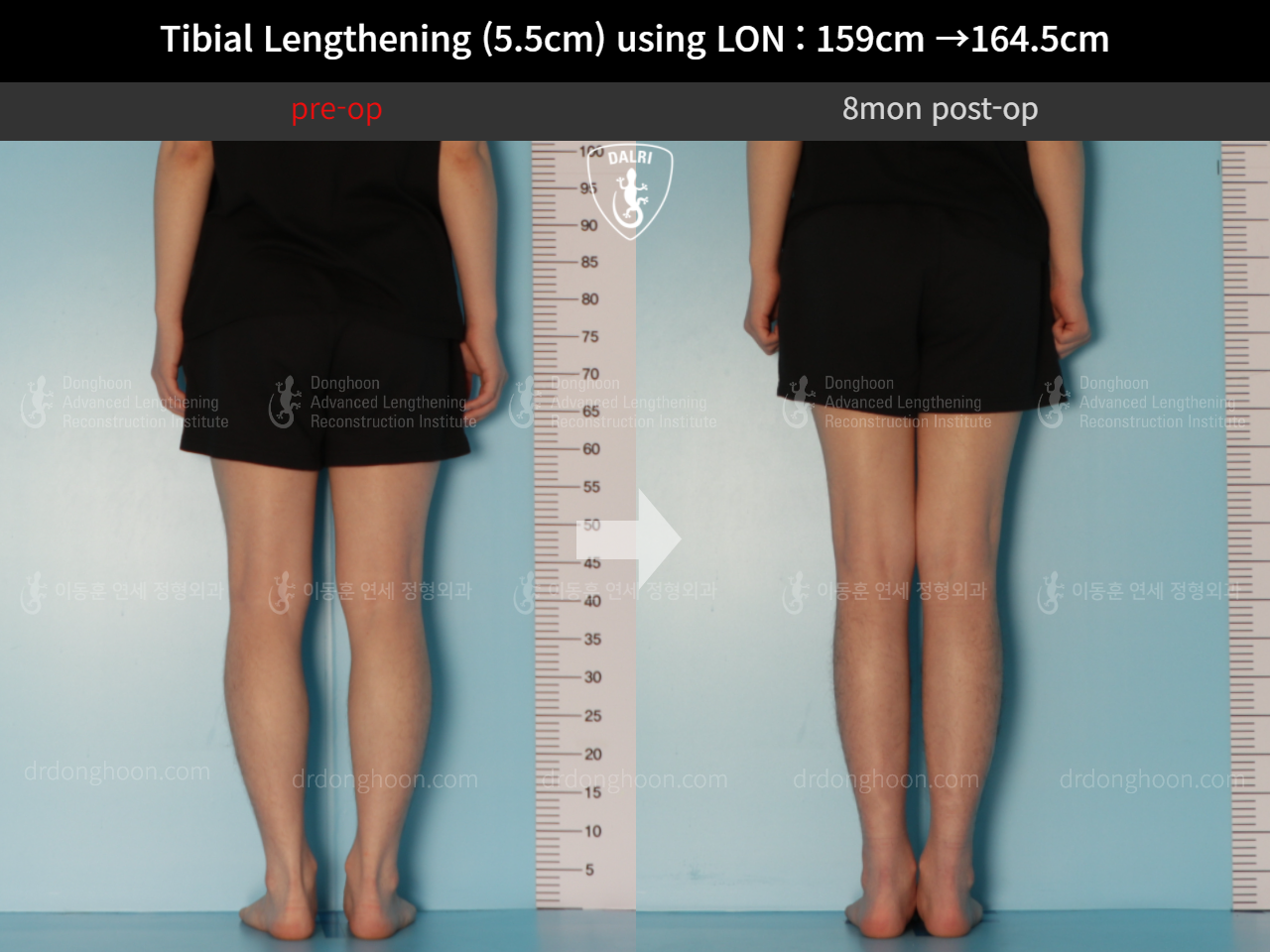 Before and after cll lon, case 10444923, image 6, Dr. Donghoon institute (DALRI)