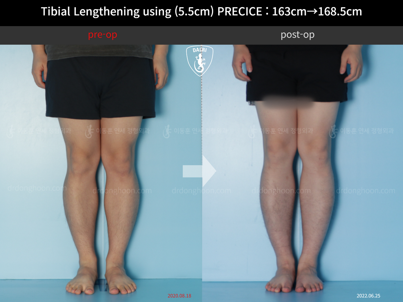 Before and after cll precice, case 12336162, image 4, Dr. Donghoon institute (DALRI)