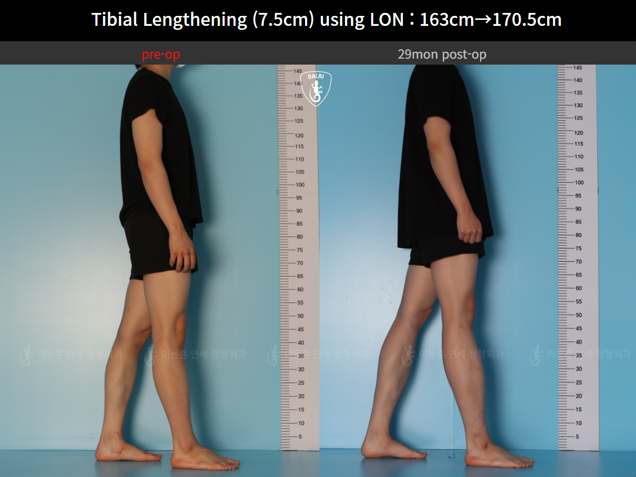 Before and after cll lon, case 127341676, image 3, Dr. Donghoon institute (DALRI)
