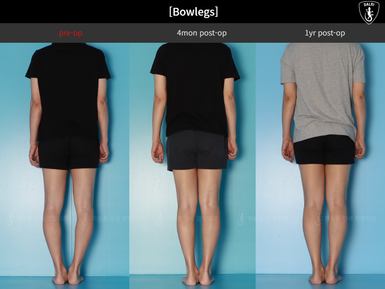 Before and after adult bowlegs, case 125438866, image 4, Dr. Donghoon institute (DALRI)