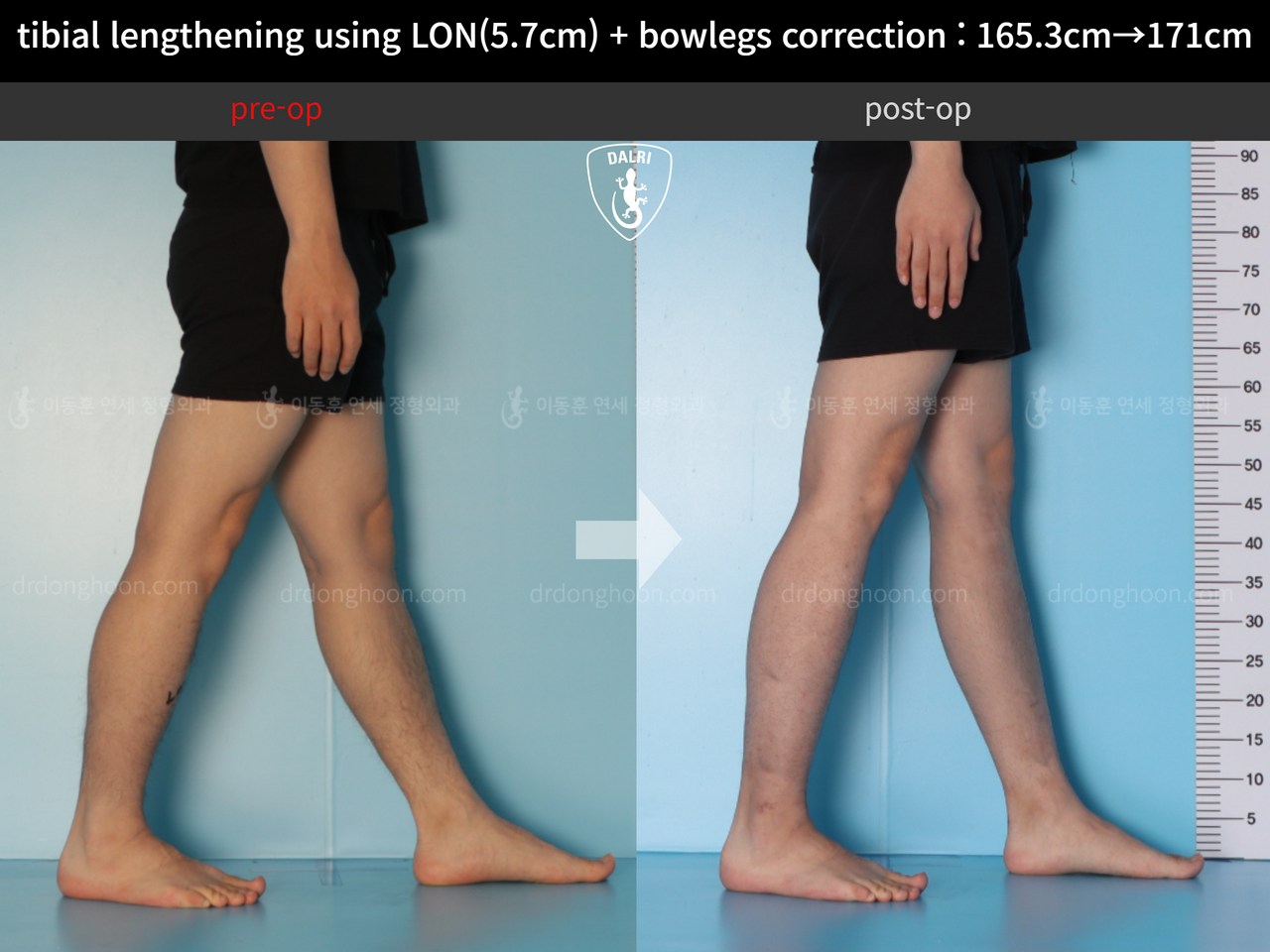 Before and after cll lon, case 12679171, image 8, Dr. Donghoon institute (DALRI)