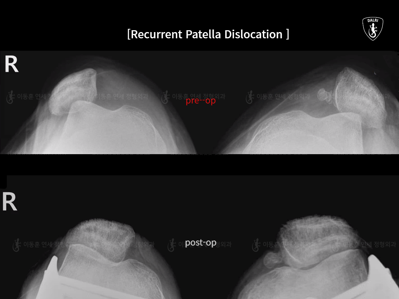 Before and after adult knock knees, case 17434917, image 8, Dr. Donghoon institute (DALRI)