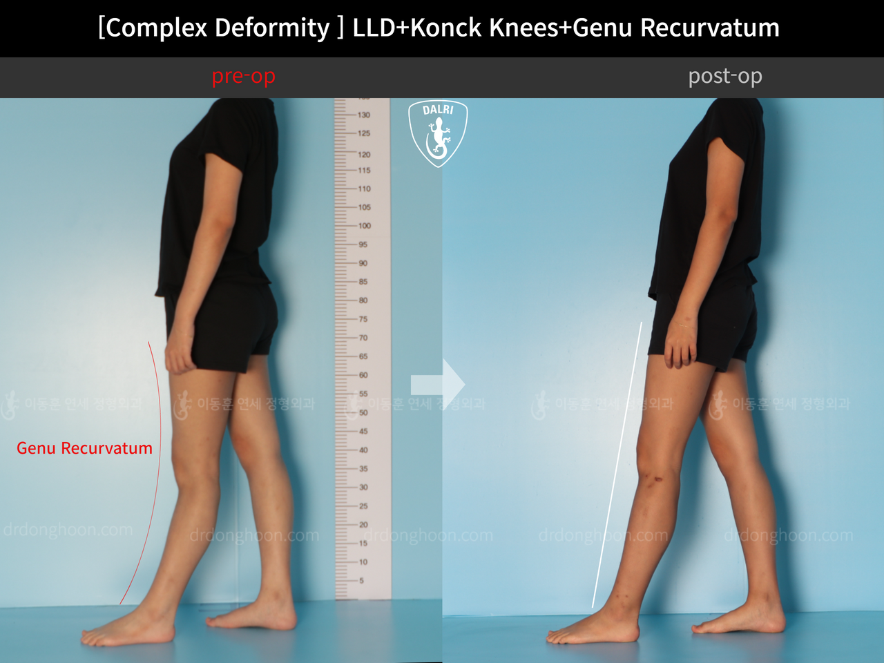 Before and after adult lld, case 12333631, image 3, Dr. Donghoon institute (DALRI)