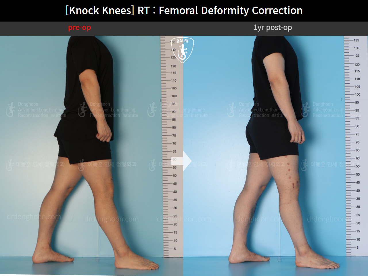 Before and after adult knock knees, case 15950751, image 7, Dr. Donghoon institute (DALRI)