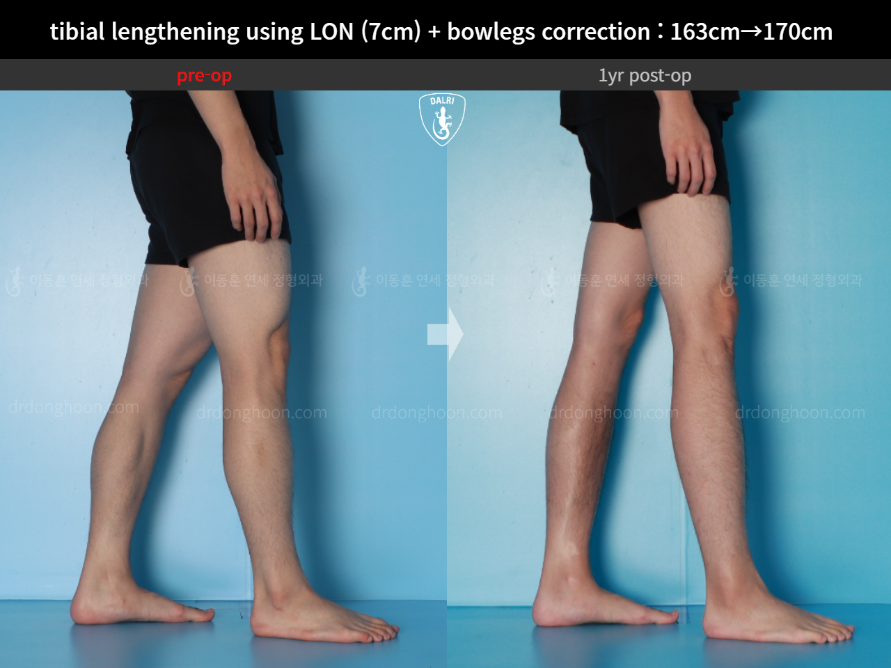 Before and after cll lon, case 16131902, image 12, Dr. Donghoon institute (DALRI)