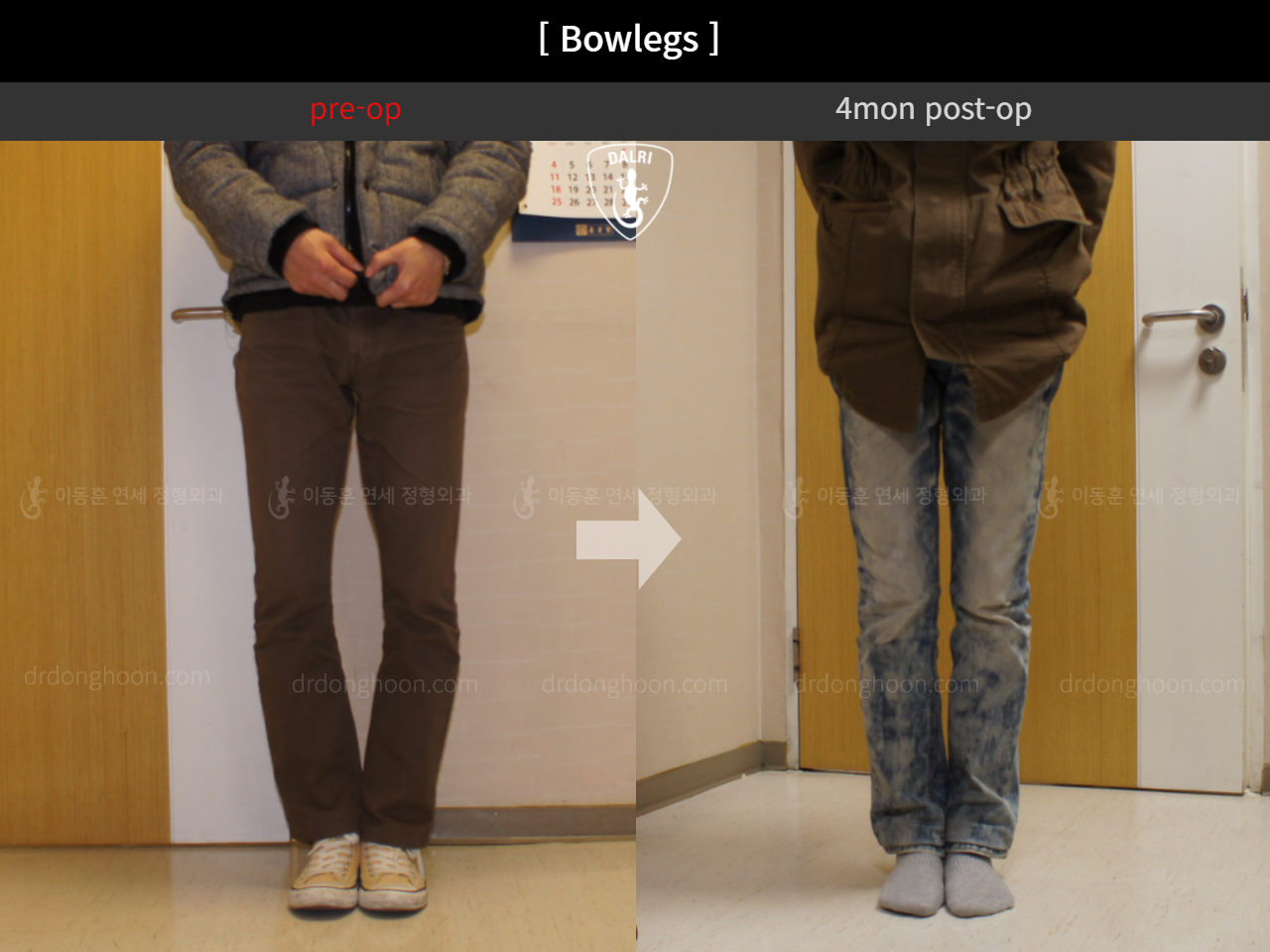 Before and after adult bowlegs, case 11078046, image 3, Dr. Donghoon institute (DALRI)