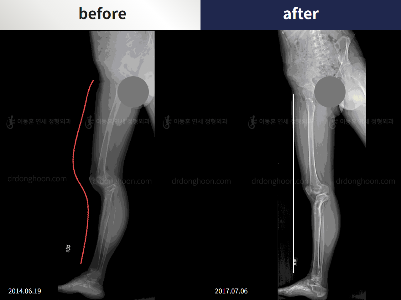 Before and after post-trauma deformity, case 4357134, image 4, Dr. Donghoon institute (DALRI)