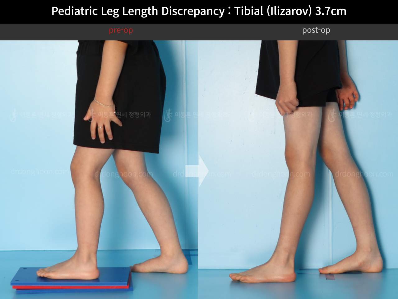 Leg Length Discrepancy (LLD) - Pediatrics - Orthobullets