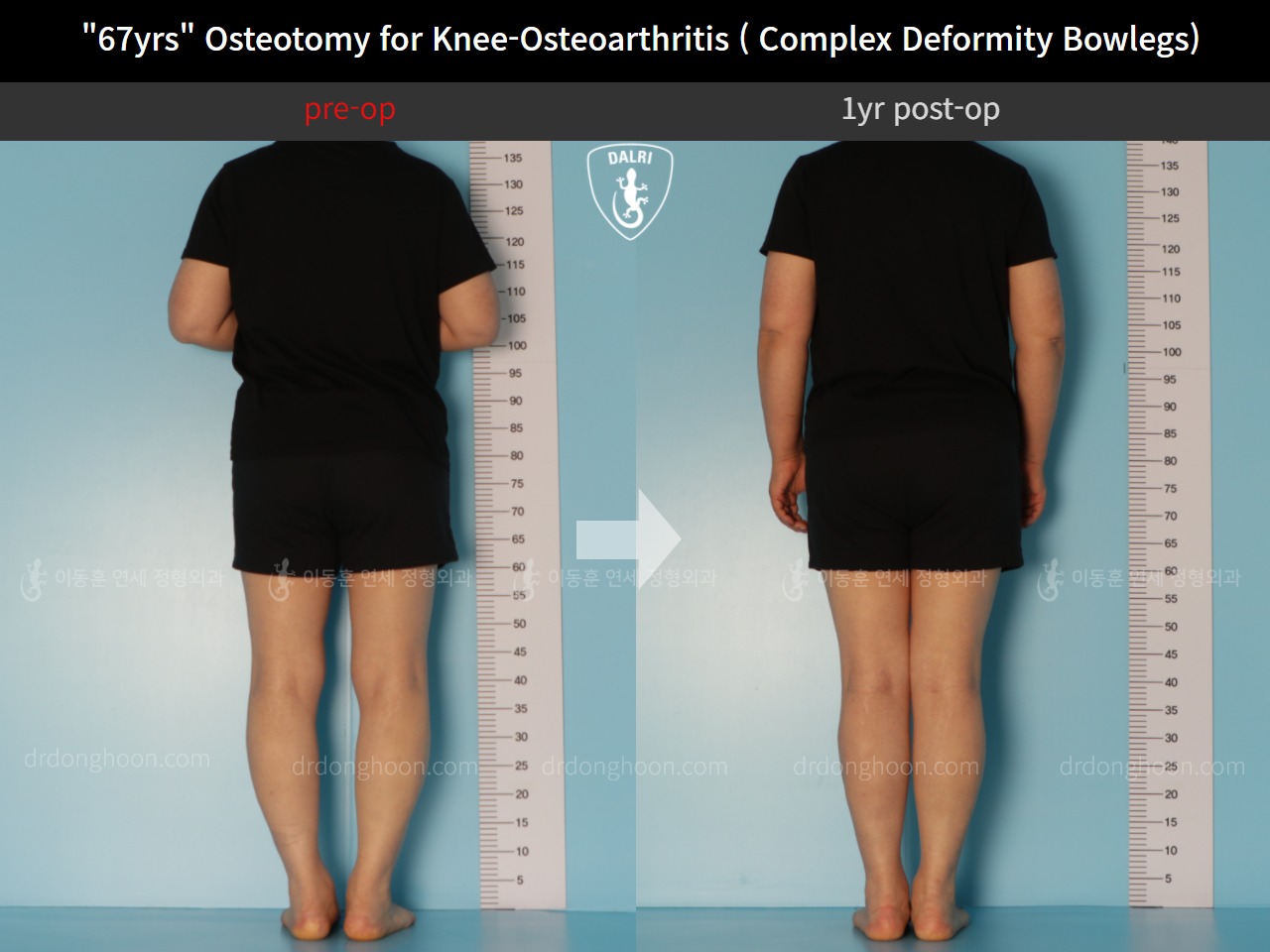 Before and after adult bowlegs, case 11339434, image 2, Dr. Donghoon institute (DALRI)