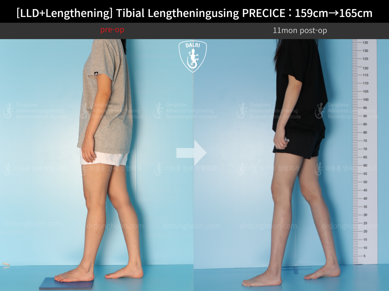 Before and after cll precice, case 13252418, image 3, Dr. Donghoon institute (DALRI)