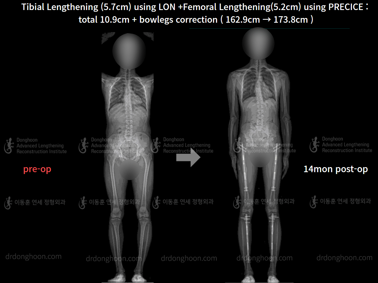 Before and after cll precice, case 8417903, image 9, Dr. Donghoon institute (DALRI)