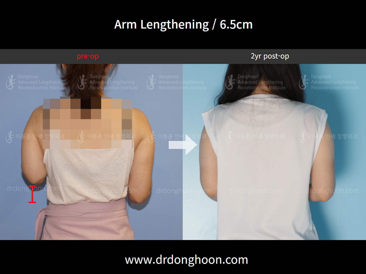Before and after arm lengthening, case 4249373, image 1, Dr. Donghoon institute (DALRI)