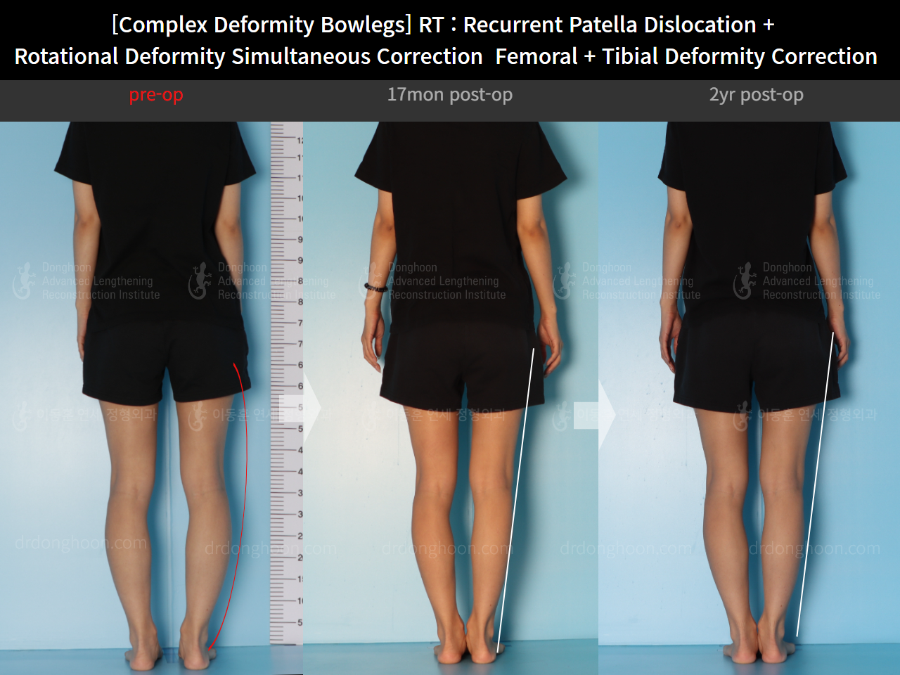 Before and after recurrent patella dislocation, case 14960900, image 2, Dr. Donghoon institute (DALRI)