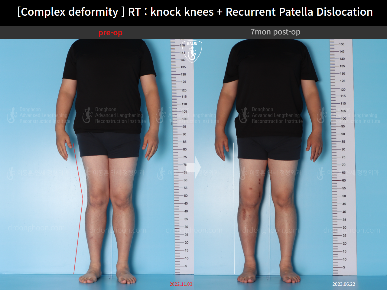 Before and after adult knock knees, case 16147021, image 1, Dr. Donghoon institute (DALRI)